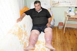 Fil hastalığına yakalanan esnaf tedavi için yardım bekliyor