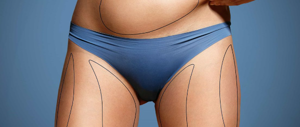 Liposuction Nedir? Ne Yapılır?