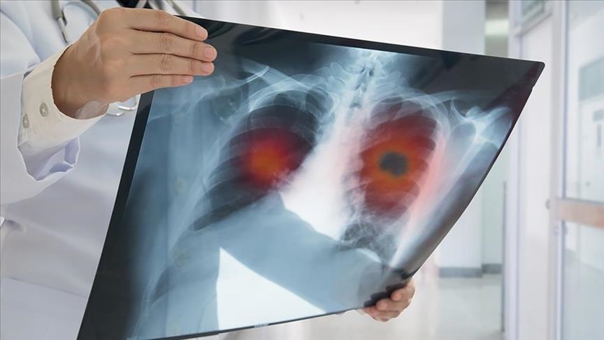 Yılda ortalama 41 bin kişi akciğer kanserine yakalanıyor