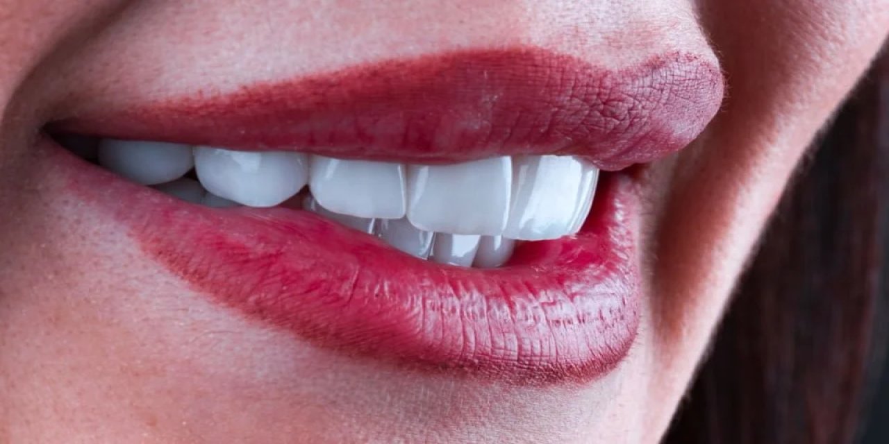 Gülüş Tasarımı Nedir?