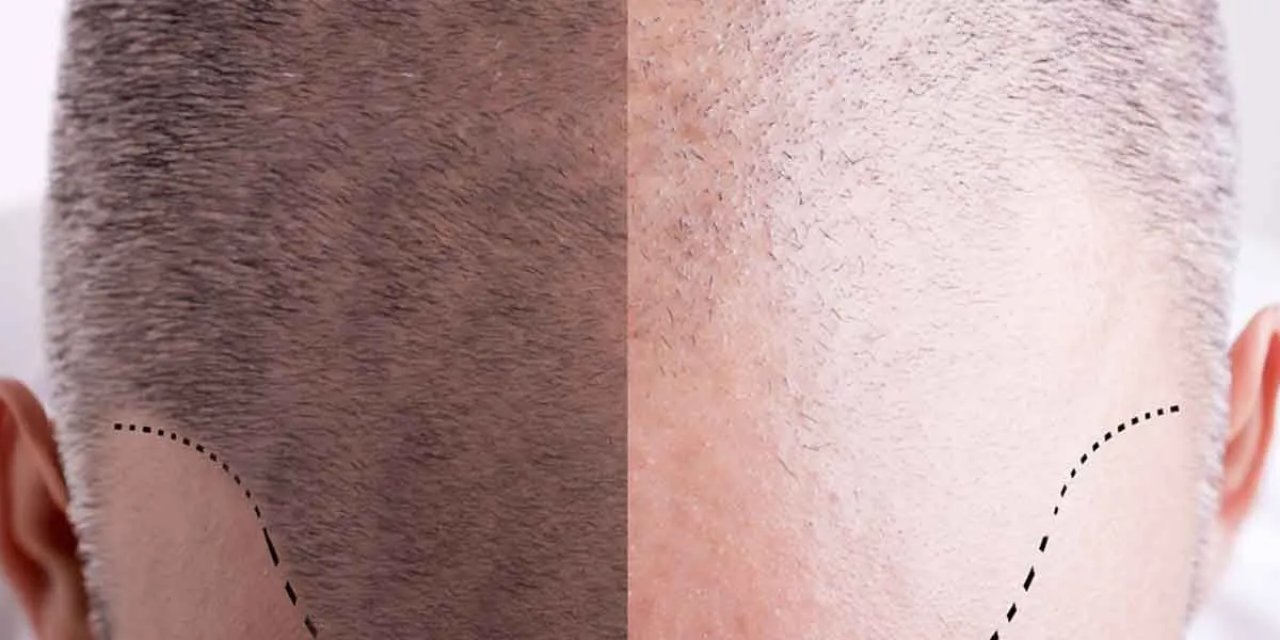 En İyi 10 Saç Ekimi Kliniği