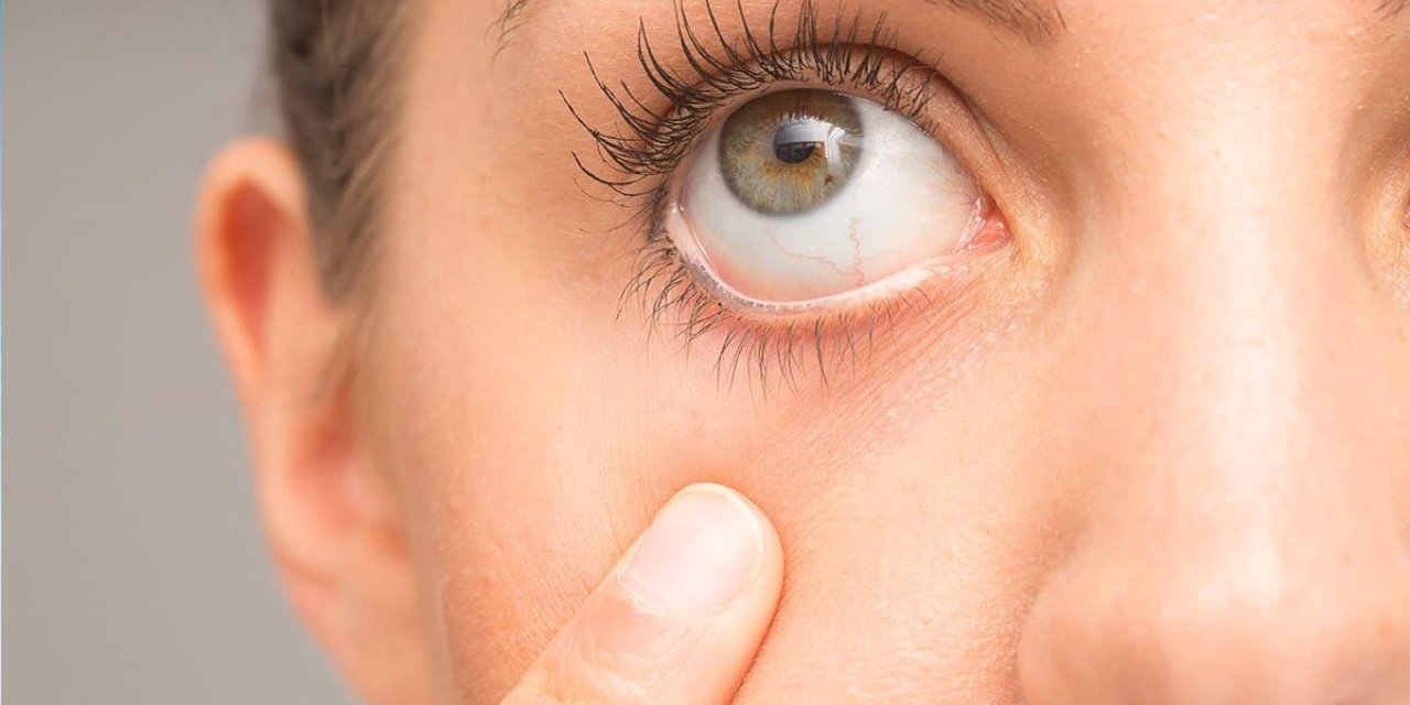 Sarı Nokta Hastalığı Nedir? Belirtileri Nelerdir?