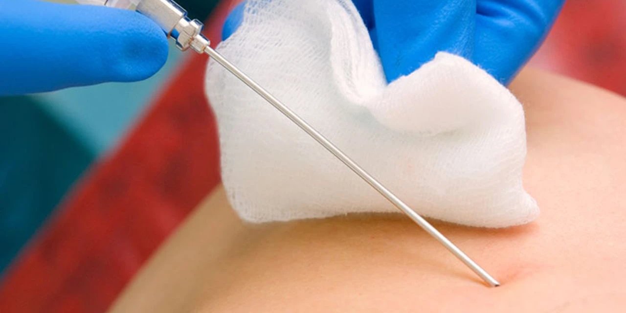 Biyopsi Nedir, Neden Yapılır?