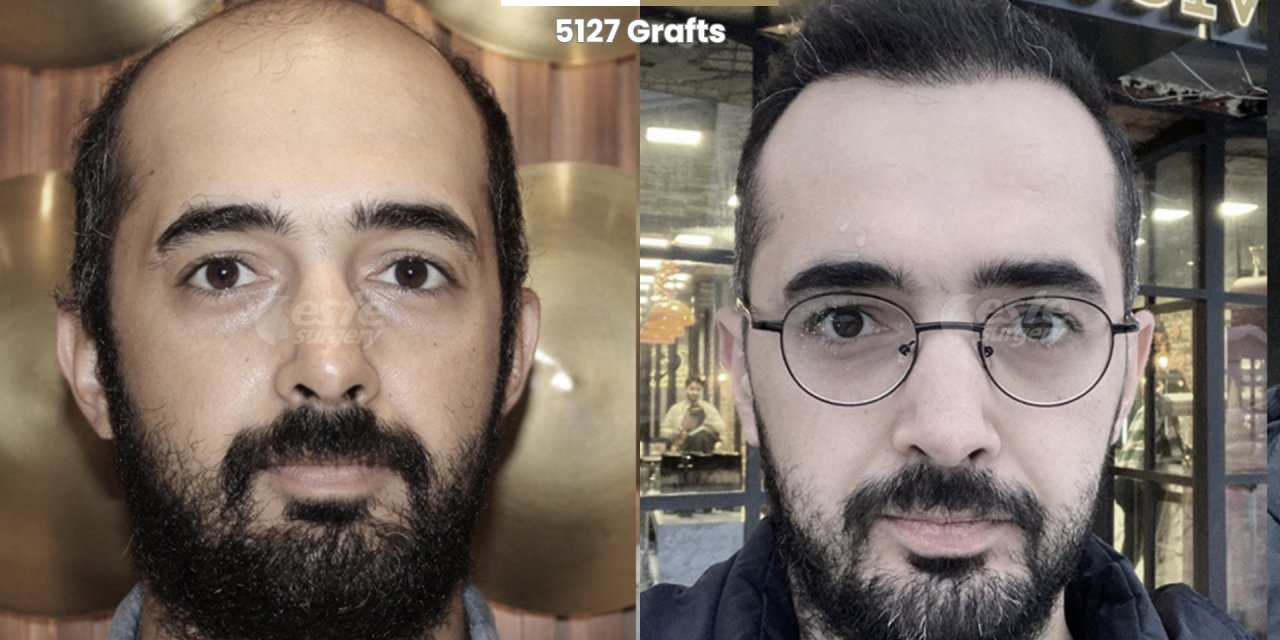 Premium haarimplantate Solutions at Este Surgery