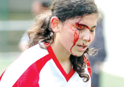 Kaşı açıldı ama oyunu bırakmadı