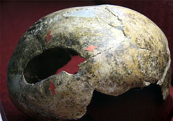 4500 yıllık ameliyatlı kafatasları